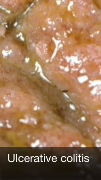 The gross appearance of ulcerative colitis
