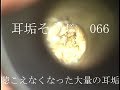 耳垢そうじ/耳がネチネチして気持ち悪い耳垢/066