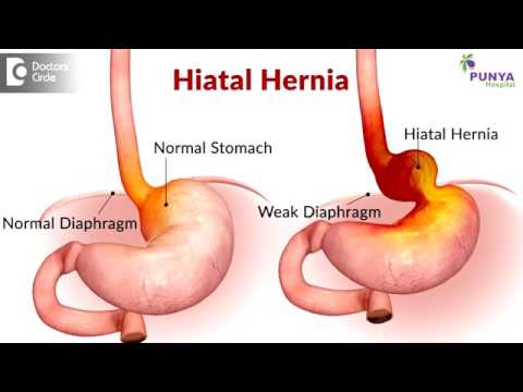 a-way-of-manage-gerd-without-medication-or-surgery---dr.-nagaraj-bangalore-|-gerd-treatment-india