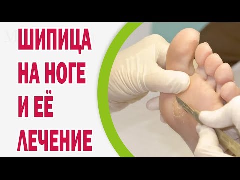 Video: Hipovitaminoze: Simptomi, ārstēšana, Cēloņi, Profilakse