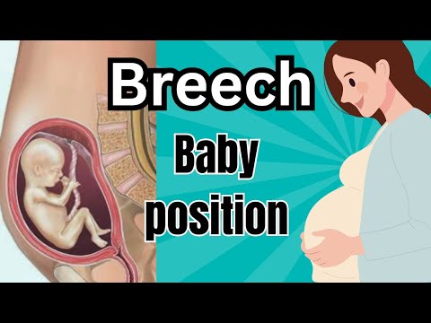 Breech baby position //Baby's position in mother womb //Dr. Sireesha ...