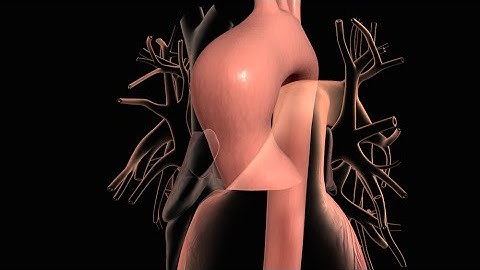 Aortic Aneurysm and Aortic Dissection