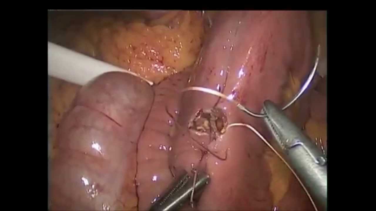 Northwestern Surgical Associates - Laparoscopic Roux En Y Gastric Bypass camera iphone 8 plus apk