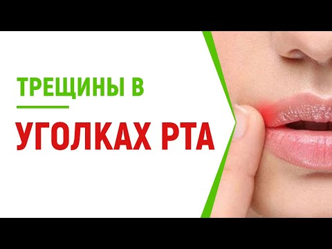 Трещины В Уголках Рта: Топ Методов Лечения, Причины Появления