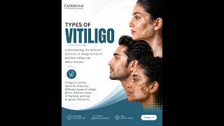 Types of Vitiligo Explained | Understanding Non-Segmental, Segmental & Other Vitiligo Types