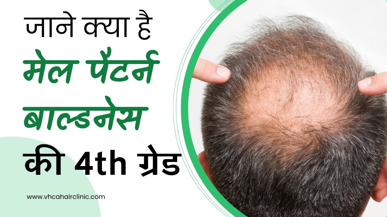 जाने क्या है मेल पैटर्न बाल्डनेस की चौथी ग्रेड | Male Pattern Baldness Treatment | VHCA  Hair Clinic