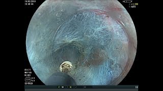 ESD of early esophageal neoplasia