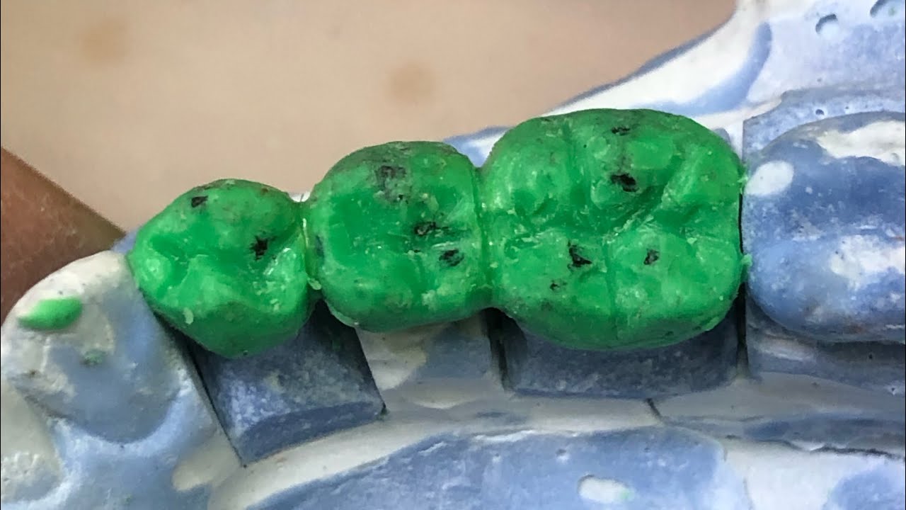 🔰学生向け　ブリッジのワックスアップ