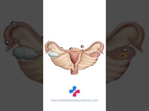 Video: Ektopisk graviditet