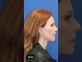 Facelift transformation for a younger tighter jawline