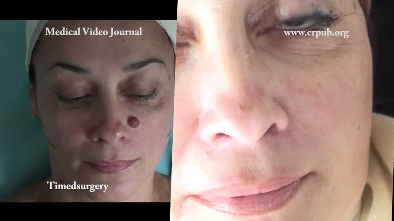 Facial Nevus 27