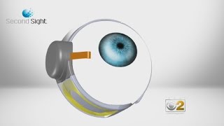 Download Lagu With New Retinal Device, Blindness May Be Fading MP3