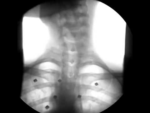 Cervical and Thoracic Video Fluoroscopy  www chiropractorinbellevue com