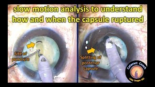 Slow motion analysis of posterior capsule rupture in cataract surgery