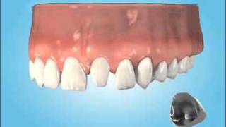 Crowns at Cathedral Dental Clinic