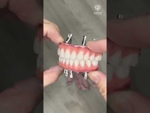 طقم الأسنان الثابت على 4 زرعات فقط