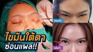 แก้ถุงใต้ตาไร้แผล ไม่ต้องตัดหนังตา  ธีรพรคลินิก หมอชลธิศ