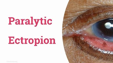 Paralytic Ectropion or Facial Nerve Palsy