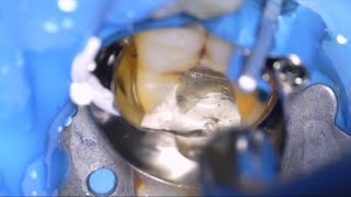 Deep Caries Molar Treatment Step by Step - Matrix in Matrix Technique