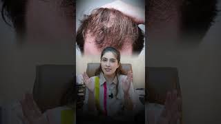Do you really have to use Minoxidil for life?”  #healthyskin #cosmeticdermatology  #dermatologist