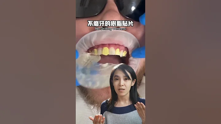 準新娘必看，快速且便宜擁有明星般笑容的方法#牙齒美白貼片 - 天天要聞