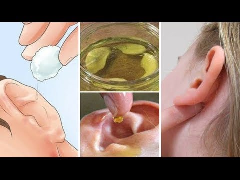 Vidéo: L'ail Dans L'oreille: Avantages Et Risques Pour Les Maux D'oreilles