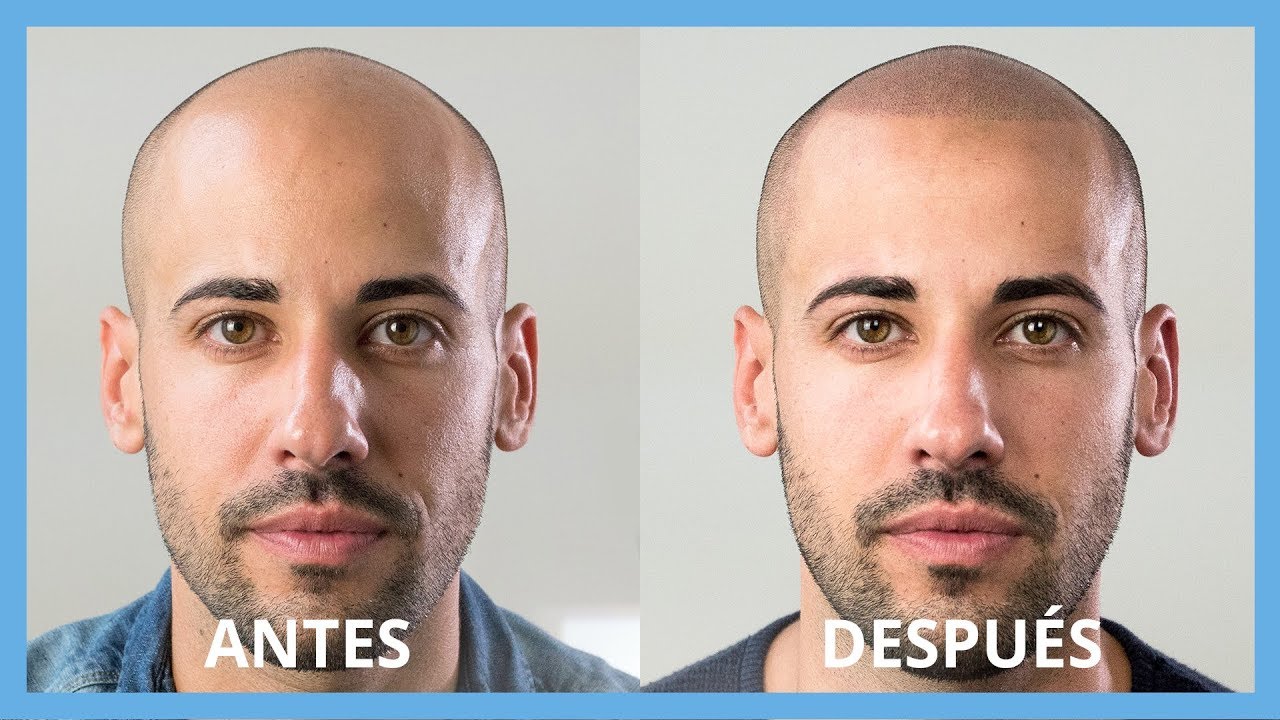 Resultados INCREÍBLES de Micropigmentación Capilar con Hello Capilar!