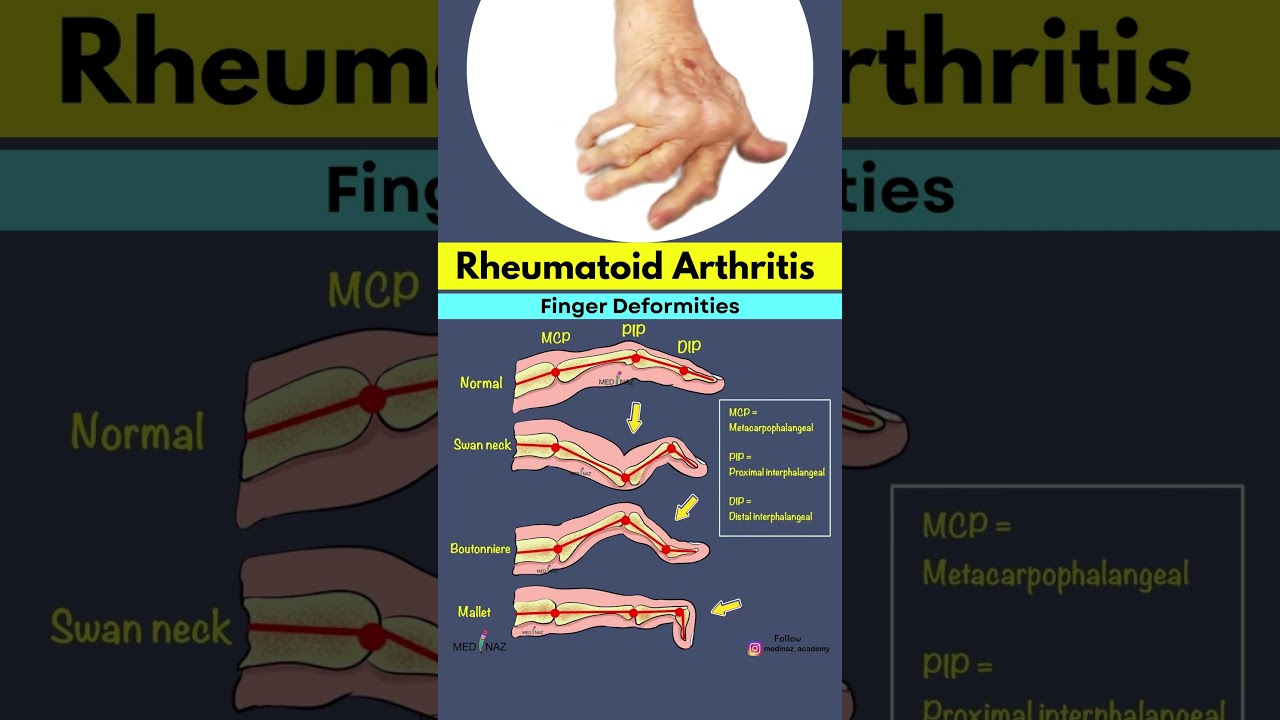 Rheumatoid Arthritis Finger Deformities Explained Swan Neck Boutonniere Mallet