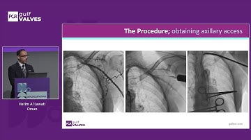 Redefining standards: TAVI in the era of lifetime management, beyond high-risk patients