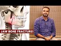 Jaw bone fracture  dr sree charan