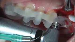 Mguide Surgery