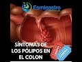 Síntomas de Pólipos en el Colon