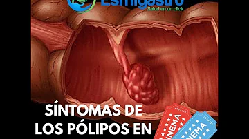 ¿Cuáles son los síntomas de los pólipos cancerosos en el colon?