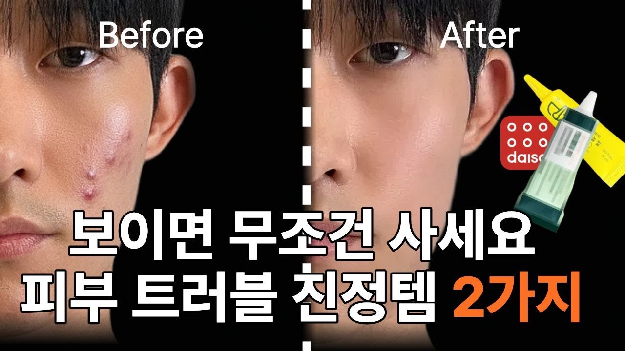 광고❌ 여드름 10년차가 강력 추천하는 다이소 단돈 3천원 제품