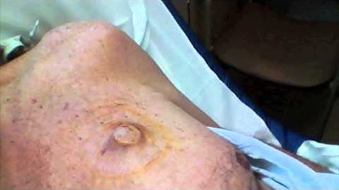 How to Access an Indwelling Vascular Port