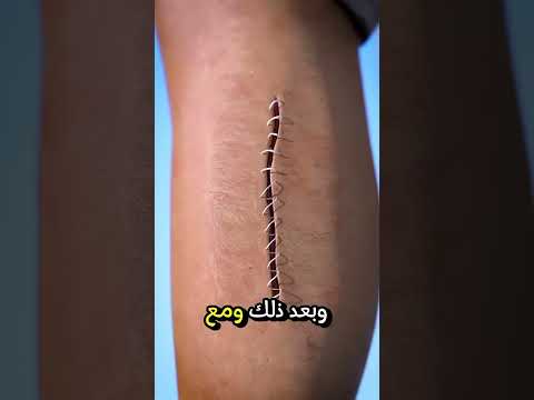 كيف تساعد الغرز على التئام الجرح 