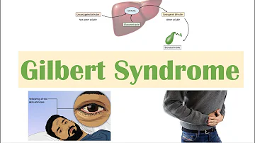 What can I eat with Gilberts syndrome?