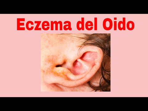 Vídeo: Eczema Del Oído: Síntomas, Causas, Diagnóstico, Tratamiento, Señales De Advertencia