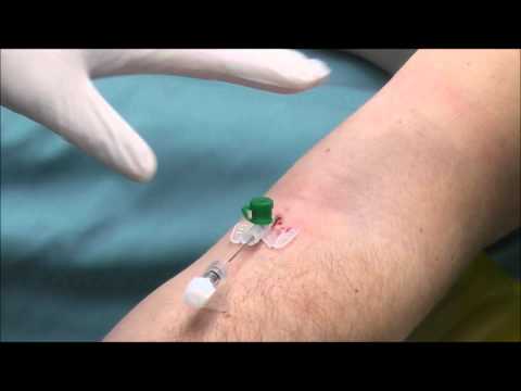 Venflon (intravenous cannula) insertion . Few examples