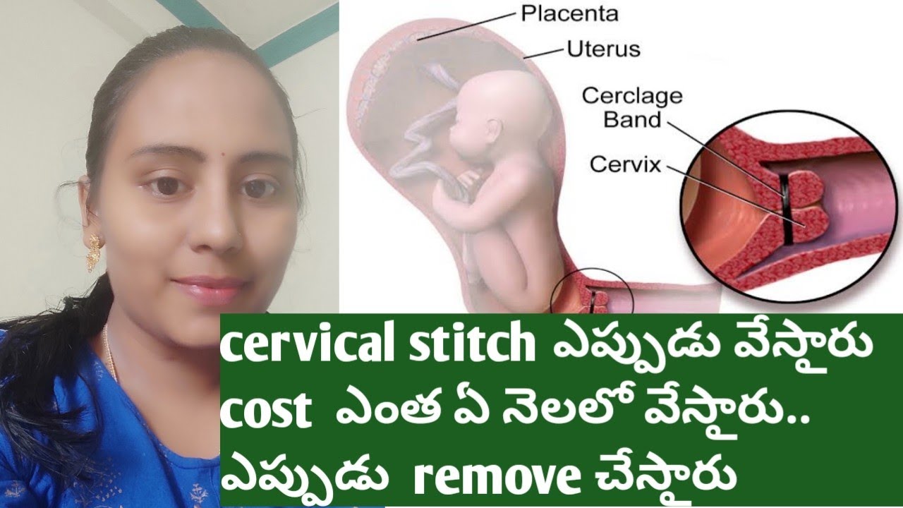 cervix weak, cervical stitch... for pregnant women.. YouTube
