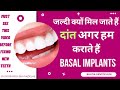 जल्दी क्यों मिल जाते हैं दांत अगर हम कराते हैं BASAL IMPLANTS