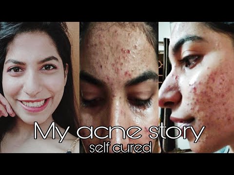 My pimple story Part 1 treatment, and causes | How to reduce pimples and pimple scars | Acne