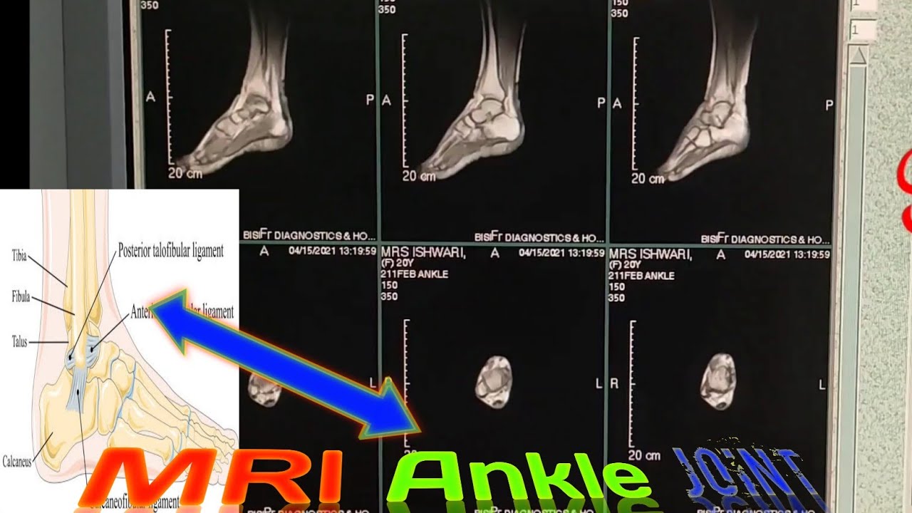 How to Do of Ankle joint MRI planning /Anatomy of Ankle Joint/ Ankle MRI A2Z medical Guru G