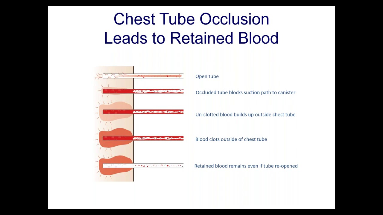 Active Clearance of Chest Tubes in Cardiac Surgery (Gillinov)