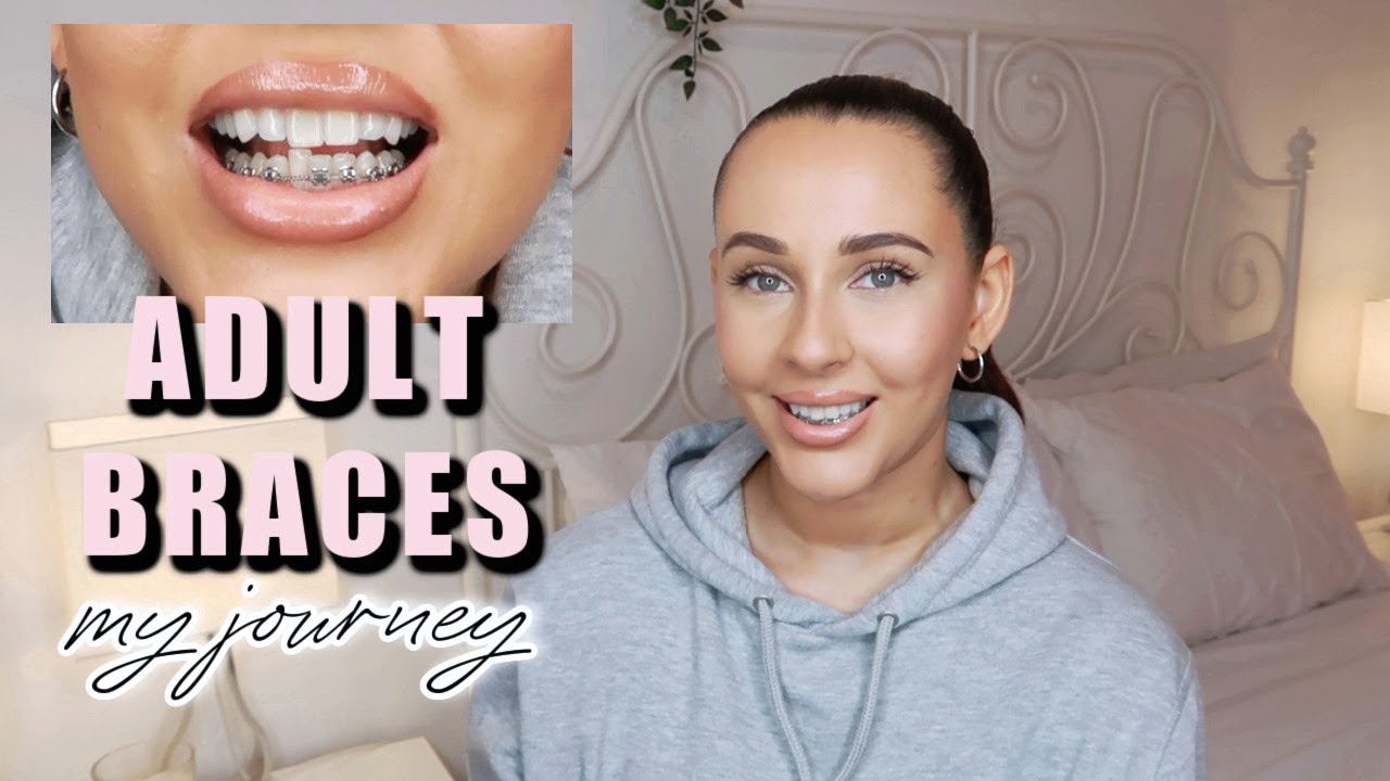 I GOT ADULT BRACES! MY BRACES JOURNEY • 1 WEEK UPDATE, PAIN & TIPS