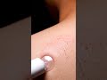 “Deep Pore Blackhead Vacuum Removal — Satisfying Skincare Transformation!”