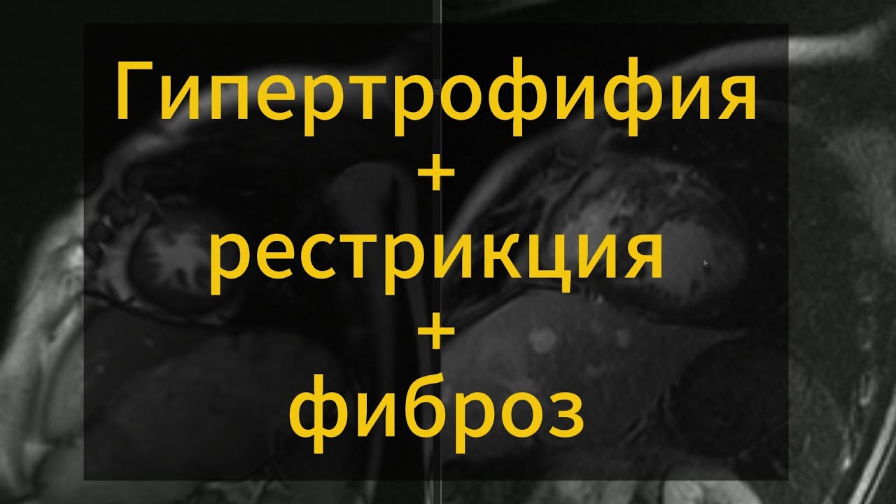 Разбор случая МРТ сердца