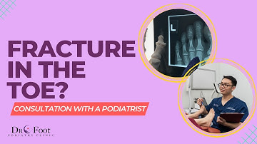 WHAT TO DO WITH A FRACTURED TOE?! **ASK A PODIATRIST**