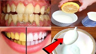 Teeth whitening at home baking soda | toothpaste that actually works