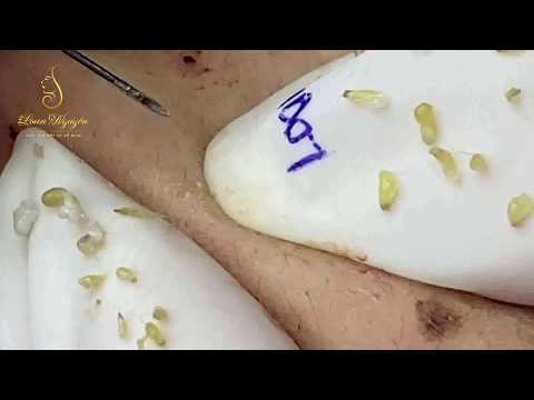 Video Skin care_ REMOVAL BLACKHEADS (89) | Loan Nguyen - youtube